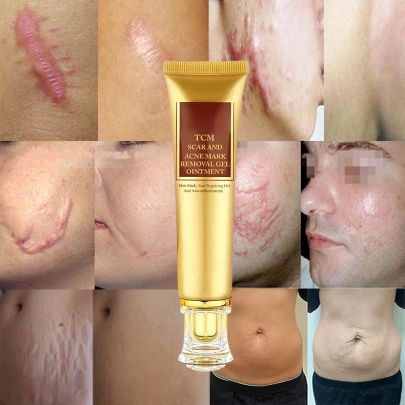 Crème Anti-Vergetures et Anti-Acné-Traitement des Cicatrices (1 acheté = 1 offert)