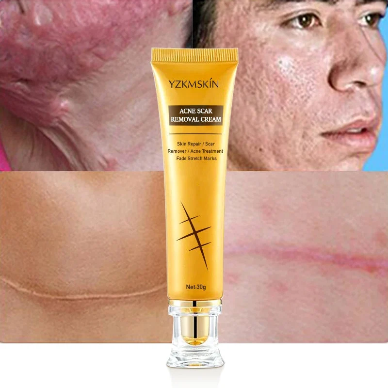 Crème Anti-Vergetures et Anti-Acné-Traitement des Cicatrices (1 acheté = 1 offert)